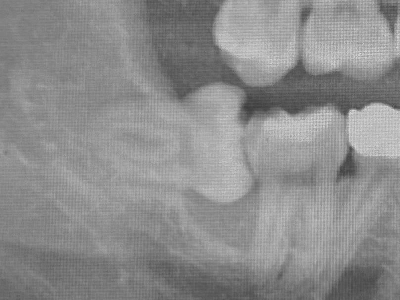 Keep Wisdom Teeth and IV Sedation In-house